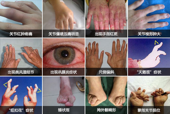 貴陽強(qiáng)直醫(yī)院類風(fēng)濕癥狀.jpg