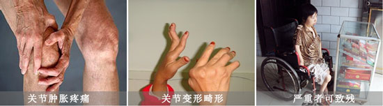 貴陽強(qiáng)直醫(yī)院類風(fēng)濕會導(dǎo)致關(guān)節(jié)腫痛、畸形、致殘.jpg