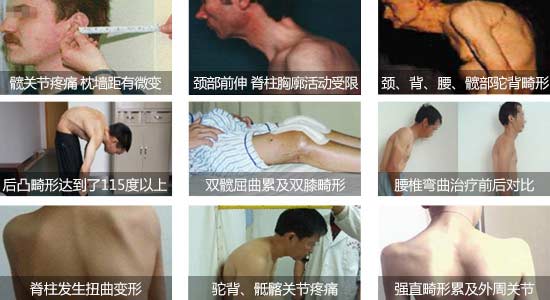 貴陽(yáng)強(qiáng)直醫(yī)院強(qiáng)直性脊柱炎給患者身體帶來(lái)危害.jpg