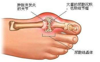 貴陽(yáng)強(qiáng)直醫(yī)院足部痛風(fēng)尿酸結(jié)晶體的形成.jpg