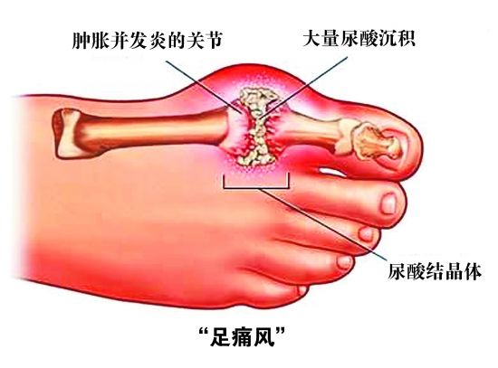 貴陽(yáng)強(qiáng)直醫(yī)院足部痛風(fēng)尿酸結(jié)晶體的形成.jpg
