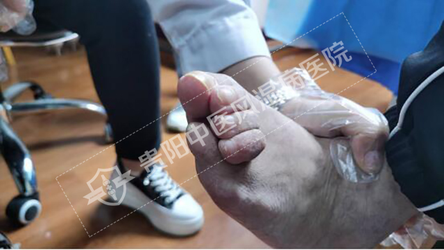 類(lèi)風(fēng)濕導(dǎo)致的指關(guān)節(jié)畸形殘疾2.jpg